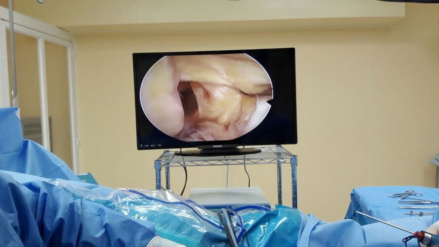 Fractura de radio distal