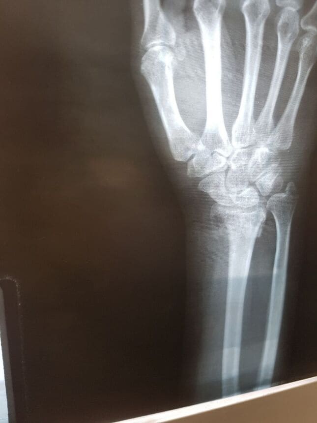 Fractura de radio distal